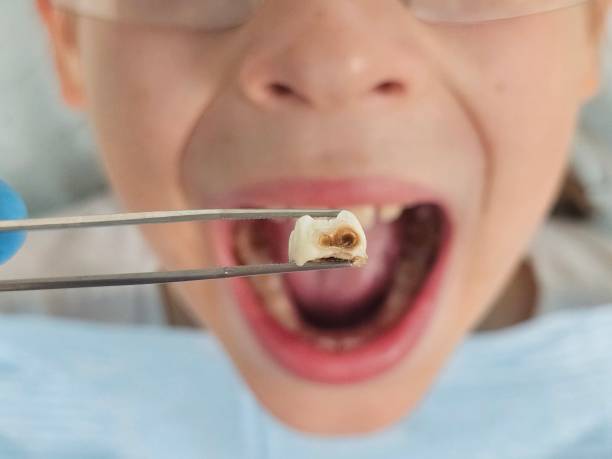Best Emergency Treatment for Toothache in Morrisville, NY